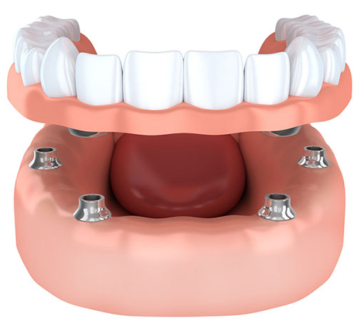 all-on-4-dental-implants-img
