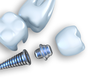 dental-implant-img