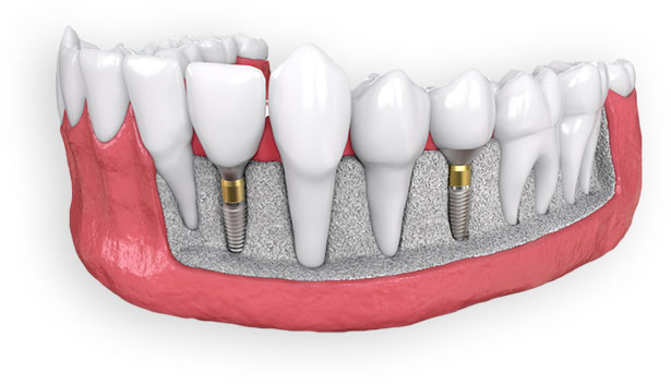 dental-implant-rendering-img