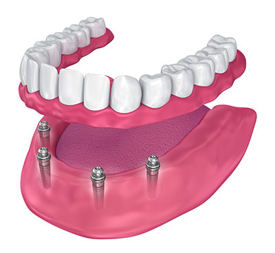 implant-overdentures-img