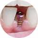 Titanium Dental Root Implant